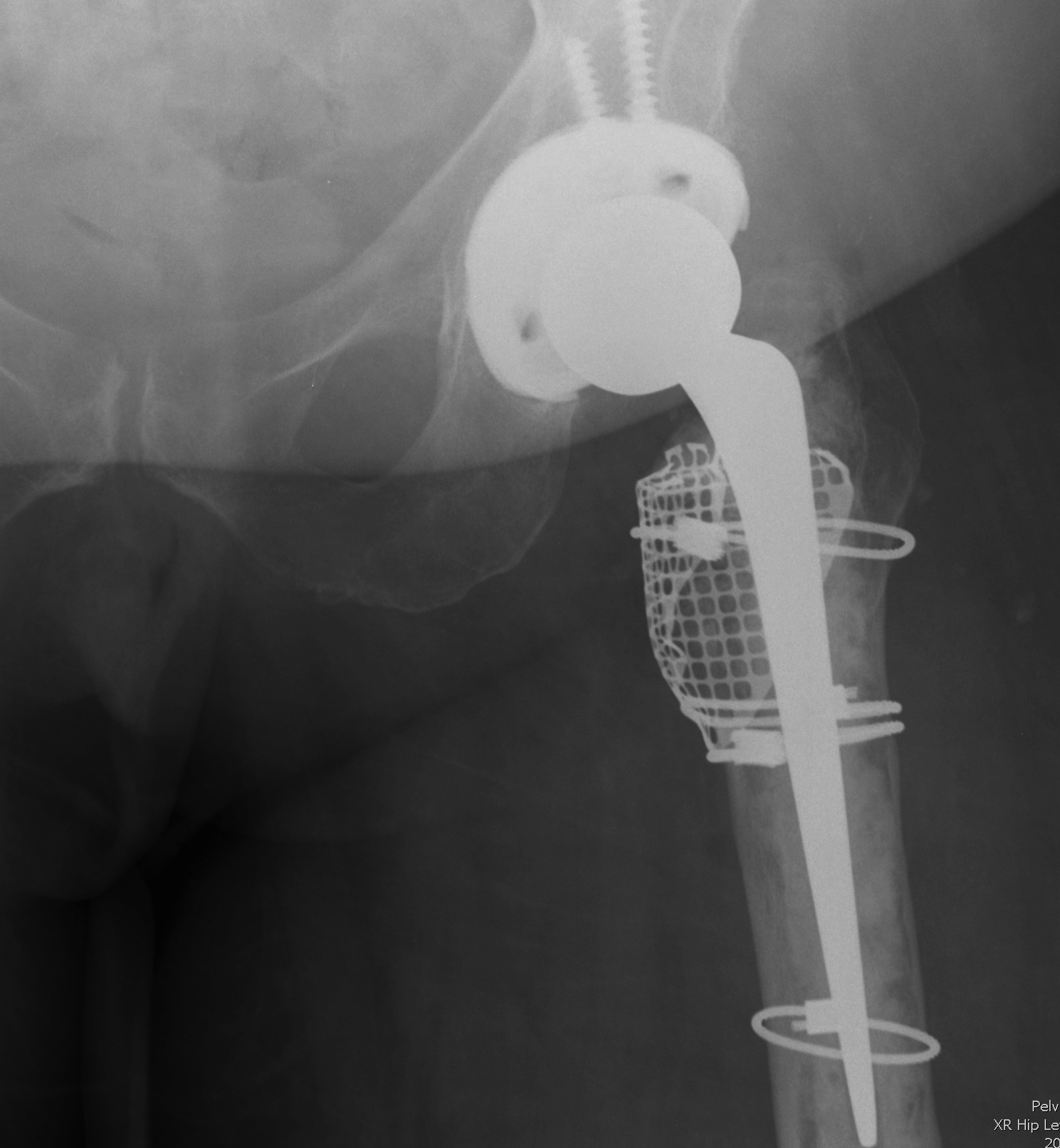 Revision Femur Type IIIA Post Mesh and Impaction Bone Grafting